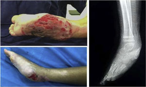 Exposed Gustilo-Anderson III-B calcaneus fracture and chronic Cierny-Mader III-A osteomyelitis.