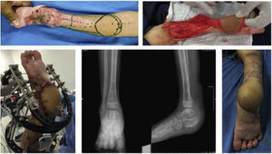 A reverse flow sural flap was created with correction of equinus deformity using an external Ilizarov-type splint, bone curettage of the calcaneus and lengthening of the Achilles tendon.