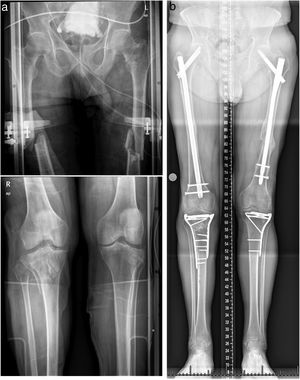 a)Radiografías AP preoperatorias de un varón de 64años que muestran fractura pertrocantérica 31-A1 y fractura diafisaria ipsilateral 32-B2 conminuta en fémur izquierdo, FDF contralateral y fracturas bilaterales en meseta tibial. b)Placas AP postoperatorias que muestran la fijación con PFNA (DePuy Synthes) femoral proximal largo en fémur izquierdo.