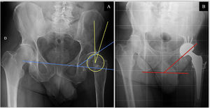 Radiological measurements. (A) Preoperative anteroposterior X-ray of the patient 9's pelvis. Wiberg angle measurement (yellow): angle between the vertical with the centre of rotation of the femoral head and the superolateral edge of the acetabulum. Sharp's acetabular angle measurement (blue): intersection of a horizontal line through the inferior edge of the acetabulum (“radiological tear-drop”) and an oblique line extending from this inferior edge to the superolateral edge of the acetabular cavity. (B) Post-operative anteroposterior radiograph of the patient 9's pelvis. Measurement of the acetabular inclination angle (red): angle between a line joining the ischial spines and the oblique line tangent to the superior and inferior edge of the acetabular component.