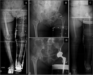 (A) Preoperative telemetry of lower limbs in patient with inguinal support brace and lift. (B) Preoperative anteroposterior X-ray of the pelvis. (C) Post-operative lower limb telemetry in patient with inguinal support brace and lift. (D) Postoperative anteroposterior radiography of the pelvis. A 68-year-old woman with sequelae of poliomyelitis in the left lower limb. She presented with Tonnis type II left hip coxarthrosis in Crowe type I and Hartofilakidis type A hip dysplasia. A preoperative Wiberg angle of 29.5° and a LLD of −3.1cm was measured on preoperative telemetry. She underwent left total hip arthroplasty with a Tritanium Stryker® double mobility cup, Exeter stem and Stryker® metal head with cerclage over the greater trochanter with wire. Postoperatively she had a LLD of .73cm and a cup inclination of 38.6°.