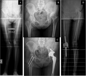 (A) Preoperative telemetry of the lower limbs. (B) Preoperative anteroposterior X-ray of the pelvis. (C) Post-operative lower limb telemetry. (D) Post-operative anteroposterior pelvis X-ray. A 63-year-old woman with sequelae of poliomyelitis in both lower limbs, operated on in childhood for Chiari type osteotomy in the left hip. She presented with Tonnis type III coxarthrosis of the left hip in Crowe type II and Hartofilakidis type A hip dysplasia. A preoperative Wiberg angle of 30.7° and a LLD of −4.7cm was measured on preoperative telemetry. She underwent Continuum Zimmer® left total hip arthroplasty, Furlong JRI® cemented stem and ceramic-alumina head and cup reconstruction with screw-retained femoral head autograft. Postoperatively, the patient had a LLD of 2.2 and a cup inclination of 35.2°. On the contralateral side she had an arthritic genu valgum treated with a semi-constrained knee prosthesis and a hip fracture treated with cannulated screws.