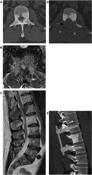Male, 58 years old. L1 prostate cancer spinal metastasis with epidural spinal cord compression type 2 according to Bilsky classification with impairment of neurological function to the lower limbs. Decompression, debulking and stabilization with carbon fiber reinforced PEEK instrumentation by posterior approach.
