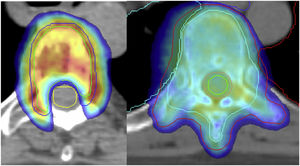 Comparison of dose adjustment in SBRT vs. conventional radiotherapy.
