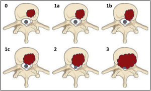 Schematic representation of the spinal cord compression.