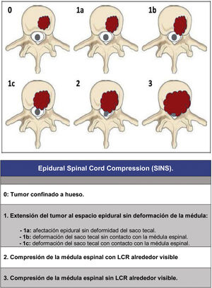 Epidural Spinal Cord Compression.