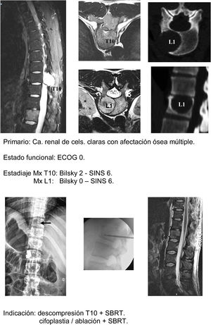 Caso clínico técnicas mínimamente invasivas.