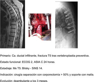 Indicación de sustitución de cuerpo vertebral.