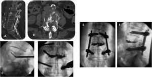 Paciente de 69 años, adenocarcinoma de pulmón metastásico. Paciente encamado dos meses con altas dosis de morfina por dolor lumbar (EVA 9) y en EEII. Radioterapia previa. A) Fractura L4 por metástasis. B) Corte axial de TC mostrando destrucción muro posterior y anterior. C) Ablación por radiofrecuencia. Electrodo dirigido al platillo superior. D) Cementación. E) y F) Fijación percutánea L3-L5. El paciente volvió a caminar con notable mejoría del dolor (EVA a 2).