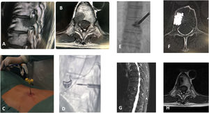 Paciente de 66 años, Metástasis tumor colon. A) y B) Lesión metastásica en T10 afectando a pedículo, muro posterior y cuerpo vertebral. C) y D) Dos momentos de la ablación por microondas. E) Cementación. F) Relleno del cuerpo vertebral en TC. G) y H) Resultado a los 12 meses en RM sin signos de progresión tumoral.