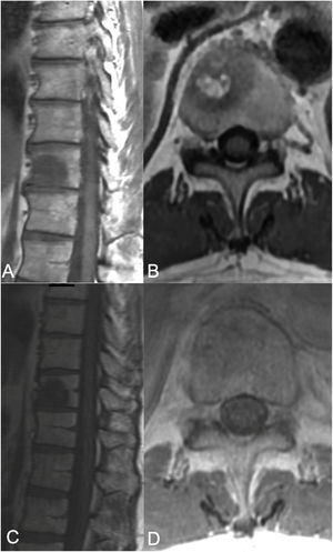 sSRS treatment. 68-Year-old female, without a previous history of cancer, presented with back pain and was found to have a T8 lesion and a lung lesion. Due to her symptomatic presentation, she underwent kyphoplasty along with a biopsy from T8 yielding metastatic adenocarcinoma consistent with adeno-carcinoma of lung. No epidural tumor extension was found (ESCC grade 0) but a left paraspinal extension was noted. Along with systemic treatment, the patient underwent SSRS treatment of 24Gy in a single treatment fraction. (A) Axial MR with contrast enhancement at T8 showing the vertebral body lesion with extension to the left posterior elements with a paraspinal component. No epidural cord compression seen. (B) 13 month follow up MR showing good local tumor control. (C) Radiosurgery treatment plan color wash. The minimum dose in the color wash (dark blue) is set to 1920cGy or 80%.