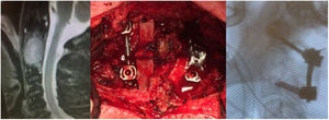 Metástasis de cáncer de pulmón en C2 tratada por vía posterior seguido de radioterapia.