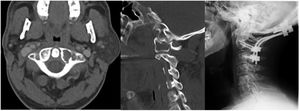 Metástasis de adenoide en masa lateral de C1 tratada por vía posterior mediante fijación occipito-cervical.