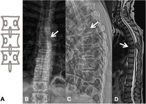 Fractura patológica dorsal por metástasis de carcinoma de pulmón. A: esquema del signo del «guiño de la lechuza»; B: RX en proyección AP de columna dorsal con acuñamiento vertebral asimétrico T7, más importante en el lado izquierdo, con imagen en vértebra tuerta por lisis del pedículo izquierdo (flecha); C: RX en proyección lateral de columna dorsal con acuñamiento vertebral T7 (flecha); D: RM de columna completa con secuencia sagital potenciada en T2, donde se ve la fractura patológica de T7 con abombamiento del muro posterior, afectación del arco posterior con masa epidural que produce compresión medular (flecha). AP: anteroposterior; RM: resonancia magnética; RX: radiografía simple.