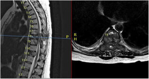 Corte sagital (izquierda) y axial (derecha) de secuencia T2 de RMN dorsolumbar, la cual evidencia múltiples lesiones metastásicas con lesión en D8 que invade el canal medular, cuerpo vertebral, pedículos, apófisis transversa y lámina.