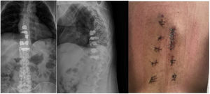 Radiografía postoperatoria AP (izquierda)/lateral (centro) dorsolumbar y heridas percutáneas dorsolumbares (derecho).