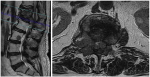 Corte sagital (imagen izquierda) y axial (imagen derecha con corte en L1) de secuencia T2 de RMN dorsolumbar que evidencia lesiones metastásicas en D12, L1, L3 con compresión del cono medular a nivel L1 por masa tumoral anterior al saco dural y por invasión pedicular.