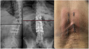Radiografía postoperatoria lateral (imagen izquierda)/AP (imagen centro) y heridas percutáneas (imagen derecha).