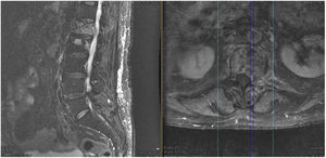 Corte sagital (imagen izquierda) y axial (imagen central con corte en L1) de secuencia T2 de RMN dorsolumbar que evidencia lesiones metastásicas en L1 y L2 con compresión del cono medular a nivel L1 por masa tumoral anterior al saco dural y por invasión pedicular izquierda.