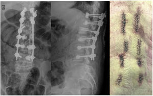 Radiografía AP (imagen izquierda) y lateral (imagen central) que muestran fijación percutánea cementada D11-D12 bilateral, L1-L2 derecha, L3-L4 bilateral y heridas percutáneas (imagen derecha).