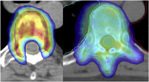 Comparación de modulación de dosis en SBRT vs. radioterapia convencional. Paciente Fundación Jiménez Díaz.