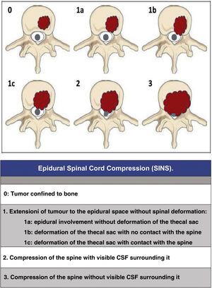 Epidural spinal cord compression.
