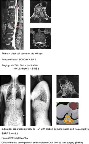 Separation and carbon instrumentation clinical case.