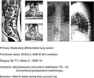 Progressive neurological tumour clinical case.