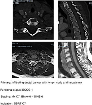 SBRT clinical case.