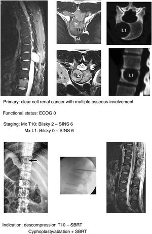Minimally invasive techniques clinical case.