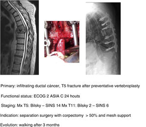 Indication for vertebral body replacement.