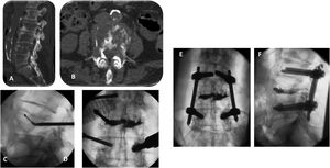 Sixty-nine-year-old patient, metastatic adenocarcinoma of the lung. Patient bedridden for two months with high doses of morphine for low back pain (VAS 9) and pain in the lower extremities. Previous radiotherapy. (A) L4 fracture due to metastasis. (B) Axial CT scan showing posterior and anterior wall destruction. (C) Radiofrequency ablation. Electrode directed to the upper plateau. (D) Cementation. (E and F) Percutaneous fixation L3–L5. The patient returned to walking with marked improvement in pain (VAS at 2).
