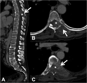 Pathological dorsal fracture due to lung carcinoma metastasis. Dorsolumbar CT with intravenous contrast. (A) 2D reconstruction in the sagittal plane, showing pathological T7 fracture with bulging of the posterior wall, involvement of the posterior arch (arrow) and epidural mass (asterisk); (B and C) axial slices at the level of the lesion, showing lytic lesion in the vertebral body, left pedicle and posterior arch (arrow), with epidural and paravertebral soft tissue component contrast uptake, and invading the spinal canal (asterisk). CT: computed tomography.