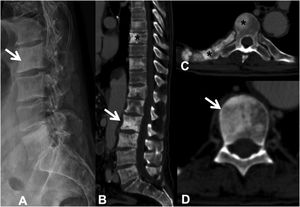 Multiple dorsal and lumbar sclerosing metastases due to prostate carcinoma. (A) Lateral X-ray of the lumbar spine, showing some of the existing sclerotic metastases (arrow); (B) CT scan of the dorsolumbar spine with dorsal (asterisk) and lumbar (arrow) sclerotic metastases; (C and D) sclerotic metastases at various levels, in the posterior arch and right rib (asterisk), and in the vertebral body (arrow). CT: computerised tomography; X-ray: plain radiography.
