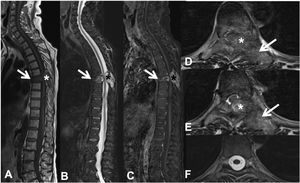 Pathological dorsal T7 fracture due to lung carcinoma metastasis. Dorsolumbar MRI with intravenous contrast. (A) T1 sequence in the sagittal plane, where there is a pathological T7 fracture with bulging of the posterior wall and hypointense signal, involvement of the posterior arch (arrow) and epidural mass (asterisk); (B) sagittal T2 sequence with hyperintense metastasis; (C) T1 sequence with intravenous gadolinium and fat suppression, the metastasis has contrast uptake; (D and E) axial T2 sequence with involvement of the posterior vertebral arch (arrow) and epidural soft tissue component producing spinal cord compression (asterisk); (F) axial T2 sequence in normal section, without compression of the spinal parenchyma. MRI: magnetic resonance.