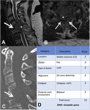 Example of the Spinal Instability Neoplastic Staging System (SINS). (A and B) T2-weighted MRI with sagittal and axial view of cervical spine, with pathological metastatic fracture of C5 with involvement of the body and posterior arch (arrow) and epidural mass (asterisk), producing spinal cord compression; (C) CT scan of cervical spine with sagittal reconstruction, showing that the metastasis is lytic; (D) table of category, description, and scoring of the lesion. CT: computed tomography; MRI: magnetic resonance imaging.