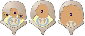 Illustrative diagram of the degrees of spinal cord compression with the epidural spinal compression scale (ESCC) of Bilsky et al.26