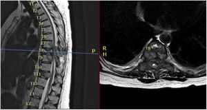 Sagittal (left) and axial (right) T2-weighted sequence of dorsolumbar MRI showing multiple metastatic lesions with lesion in D8 invading the spinal canal, vertebral body, pedicles, transverse process, and lamina.
