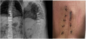Postoperative AP (left)/lateral (centre) dorsolumbar X-ray and dorsolumbar percutaneous wounds (right).