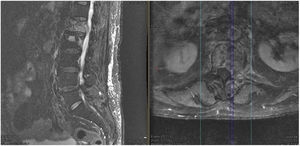Sagittal (left image) and axial (centre image with cut at L1) T2-weighted sequence of dorsolumbar MRI showing metastatic lesions at L1 and L2 with compression of the conus medullaris at L1 level by tumour mass anterior to the thecal sac and by left pedicle invasion.