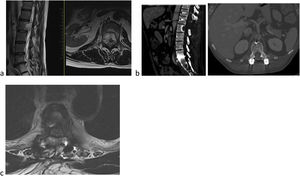 59-Year-old male. L2 body metastasis Tokuhashi 13, SINS 6, and Bilsky 2. (a) This patient has good general condition (GGC) and predicted survival of longer than 12 months. (b) Treatment is decided as partial excision and separation surgery and then SBRT. (c) To optimise preparation for SBRT, carbon fibre instrumentation is decided.