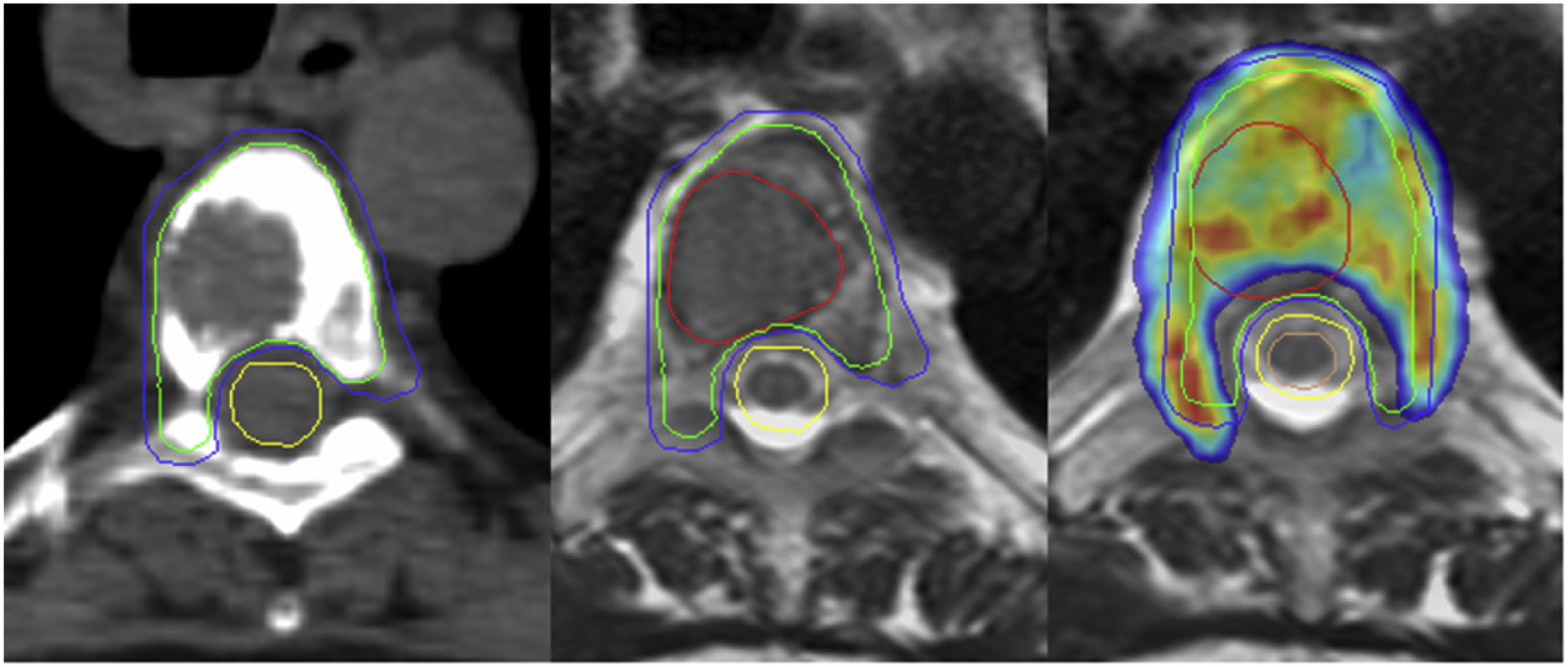 [Translated article] Role of radiotherapy in the management of spine ...