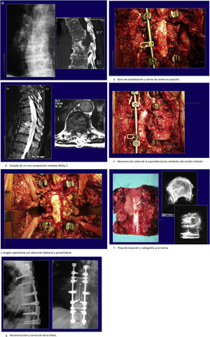 Caso clínico de paciente. Estudio de extensión negativo. a. Radiografía y tomografía computarizadas con fractura y cifosis tras fractura patológica. b. Estudio de resonancia magnética con compresión medular Bilsky 2. c. Imagen operatoria con disección bilateral y prevertebral. d. Barra de estabilización y sierras de tomita en posición. e. Momento del volteo de la espondilectomía, alrededor del cordón medular. f. Pieza de resección y radiografía de la misma. g. Reconstrucción y corrección de la cifosis.