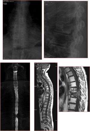 Caso clínico. CPAP nocturno. a. Radiografías y resonancias magnéticas que muestra los cambios tras RT, recurrencia de la lesión con compresión medular y de extremidad proximal de los arcos costales izquierdos. b. Pedículo derecho libre, pars libre izquierda, niveles de descompresión. Al encontrarse fracturados, el nivel estimado libre de enfermedad, debe incluir los platillos adyacentes. c. Radiografía de la pieza de resección de T7-8, extremidad proximal de costillas incluidas en la resección. d. Estudio de seguimiento a 6 años. e. Rotura de las barras, posiblemente, como consecuencia de la RT, no fusión anterior. f. Cirugía de revisión, estabilización con 4 barras. g. Ocho años. Años de evolución desde la primera intervención.