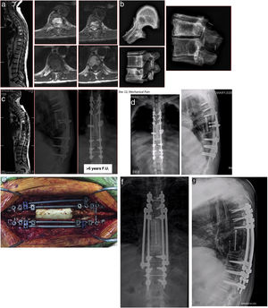Caso clínico. CPAP nocturno. a. Radiografías y resonancias magnéticas que muestra los cambios tras RT, recurrencia de la lesión con compresión medular y de extremidad proximal de los arcos costales izquierdos. b. Pedículo derecho libre, pars libre izquierda, niveles de descompresión. Al encontrarse fracturados, el nivel estimado libre de enfermedad, debe incluir los platillos adyacentes. c. Radiografía de la pieza de resección de T7-8, extremidad proximal de costillas incluidas en la resección. d. Estudio de seguimiento a 6 años. e. Rotura de las barras, posiblemente, como consecuencia de la RT, no fusión anterior. f. Cirugía de revisión, estabilización con 4 barras. g. Ocho años. Años de evolución desde la primera intervención.