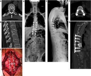 Varón de 40 años. Metástasis aislada en T10 derivada de cáncer de células renales. Resección en bloque mediante abordaje posterior y reconstrucción de la columna anterior con prótesis de titanio impresa en 3D.