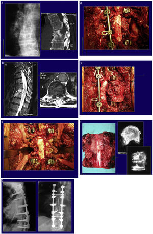 Clinical case of a patient. Negative extension study. (a) X-ray and CT with fracture and kyphosis after pathological fracture. (b) MRI with Bilsky 2 spinal cord compression. (c) Intraoperative image with bilateral and prevertebral dissection. (d) Stabilising rod and Tomita saws in position. (e) Moment of turning out of the spondylectomy around the spinal cord. (f) Resection piece and X-ray of it. (g) Reconstruction and correction of kyphosis.