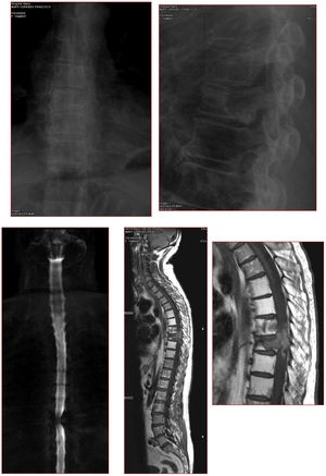 Clinical case. Nocturnal CPAP. (a) X-rays and MRI showing post-RT changes recurrence of lesion with compression of spinal cord and proximal part of left costal margin. (b) Free right pedicle, free left pars, levels of decompression. If fractured, the estimated disease-free level should include the adjacent plates. (c) X-ray of the resection piece of T7–T8, proximal part of the ribs included in the resection. (d) Follow-up study at 6 years. (e) Breakage of the rods, possibly as a consequence of RT, not anterior fusion. (f) Revision surgery, stabilisation with 4 rods. (g) 8 years of progression since first intervention.