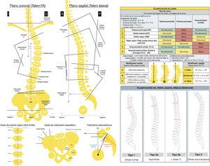 A la izquierda: mediciones radiológicas que realizar en las radiografías postero-anterior y lateral de columna total en bipedestación. Vértebra apical, la más alejada de la LSM y la más rotada. Vértebra neutra, la más proximal bajo el ápex de curva mayor cuyos pedículos no están rotados, es decir, son simétricos. Vértebra límite, las más inclinadas proximal y distal en los extremos de la curva mayor. Vértebra estable coronal, la más proximal bajo el ápex de la curva mayor que es cortada por la mitad por LSM. A: anterior; CF: cabeza femoral; CTR: cartílago trirradiado; D: derecha; HRL: línea horizontal de referencia; I: izquierda; LSM: línea sacra media; MMII: miembros inferiores; P: posterior; PA: posteroanterior; VRL: línea vertical de referencia.A la derecha: clasificación de Lenke y clasificación del perfil sagital de Abelin-Genevois.