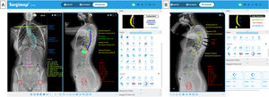 Planificación preoperatoria. A) Niveles a instrumentar, tipo y tamaño de los tornillos, y longitud y forma de las barras. B) Planificación de osteotomías de la columna posterior (PCO) a varios niveles en el ápex de la curva torácica para corregir la hipocifosis torácica (10° por nivel), y visualización de la corrección de la alineación y equilibrio sagital.